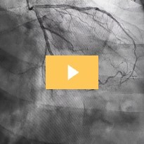 2025 Daylight Saving Time and Cardiac Effects