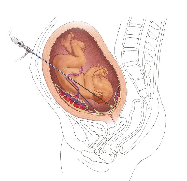 illustration of Laser Ablation for Type 2 Vasa Previa