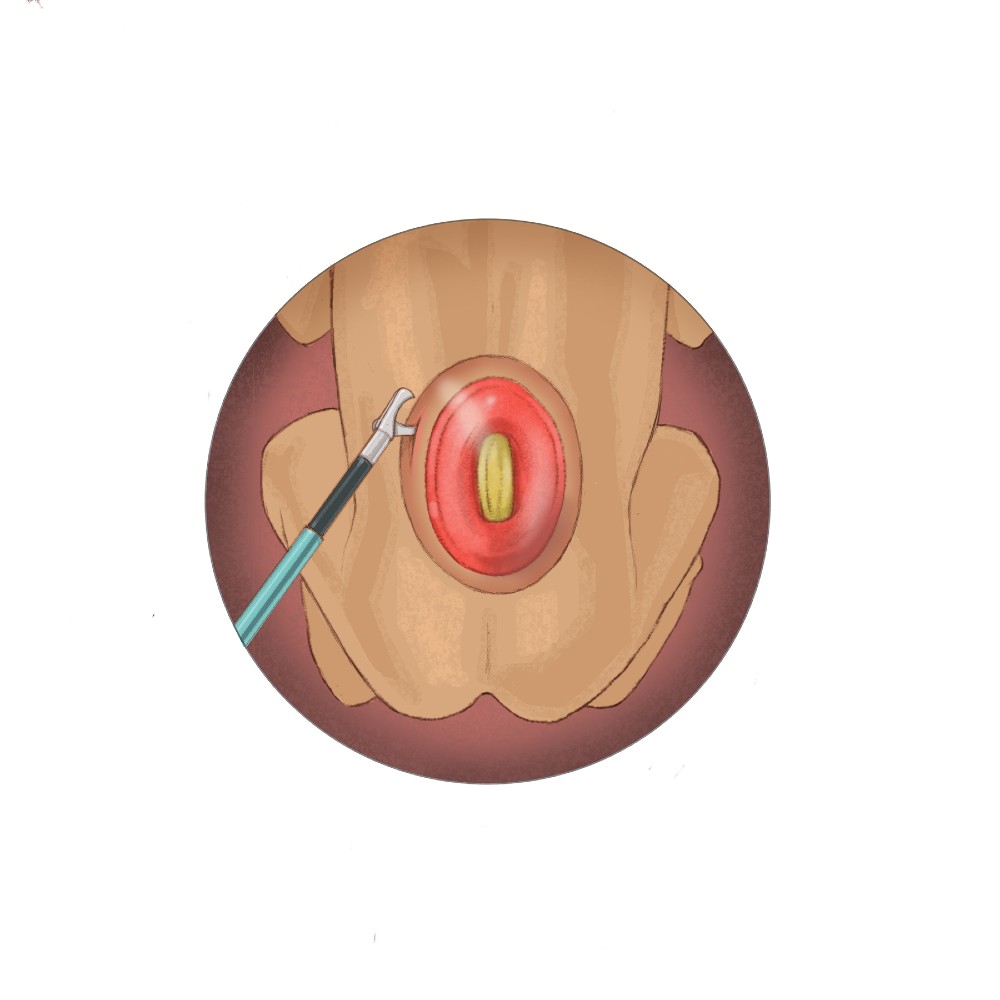 Fetoscopic Spina Bifida Repair Disection