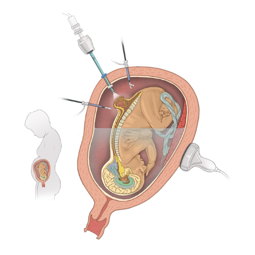 Fetoscopic Spina Bifida Repair Overview