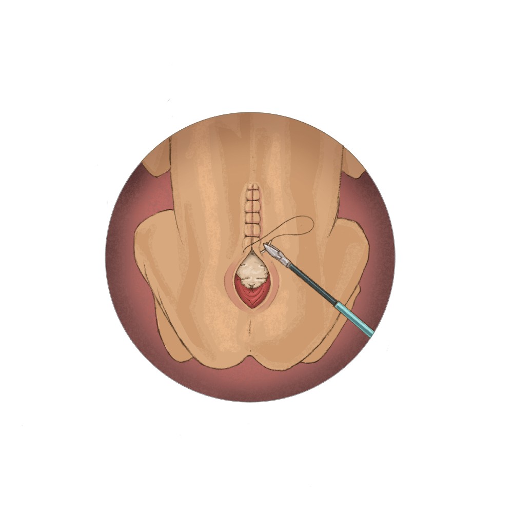 Fetoscopic Spina Bifida Repair Suture