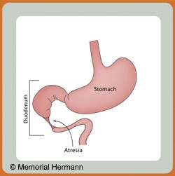 Pediatric Duodenal Atresia Stomach Illustration