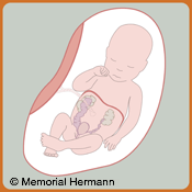 Pediatric Urinary Tract Obstruction Fetus Option One