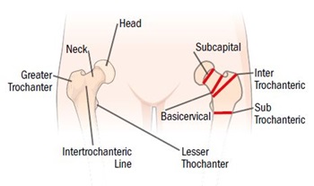 About hip fractures