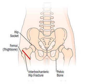 Intertrochanteric Hip Fracture