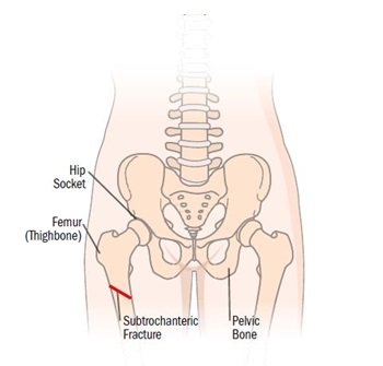 Subtrochanteric Hip Fracture