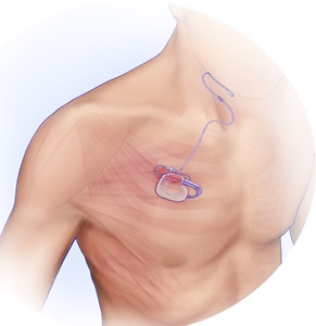 Illustration of the Inspire device