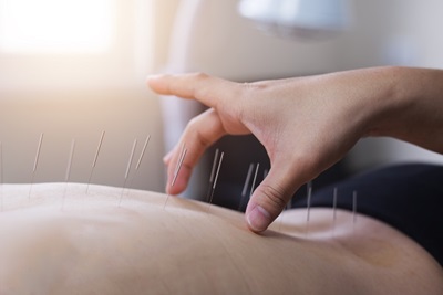 Dry Needling